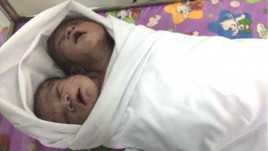 В столице Мьянмы родился здоровый ребенок с двумя головами