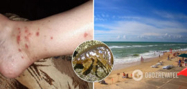 Морские блохи атакуют туристов на Азовском море: чем опасны и что нужно знать